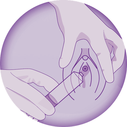 Icône illustrant l’application de la gelée dans l’urètre chez la femme